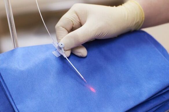 In einigen Fällen wird bei chronischer Prostatitis eine Lasertherapie eingesetzt