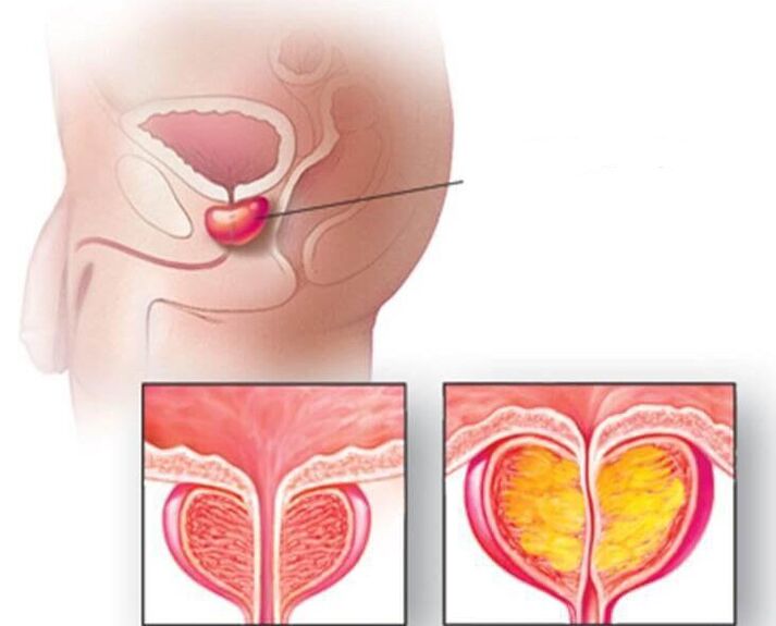 Lage der Prostata, normale und vergrößerte Prostata bei chronischer Prostatitis