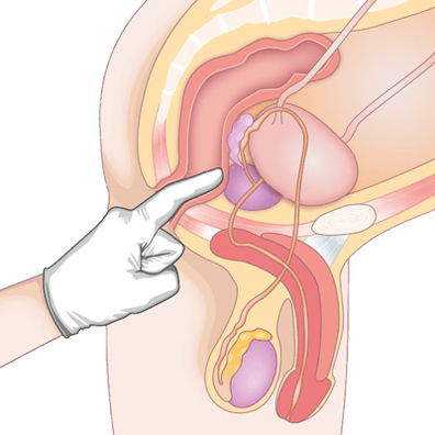 Bestimmung des Zustands der Prostata durch Abtasten zur Diagnose einer Prostatitis