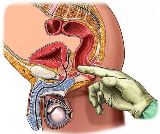 Diagnose von Prostatitis