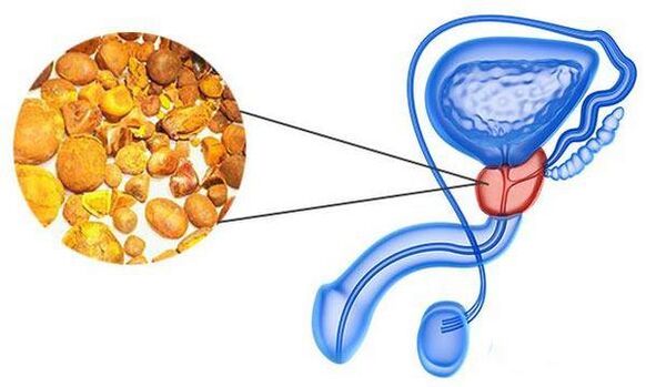 Probleme mit Prostatitis