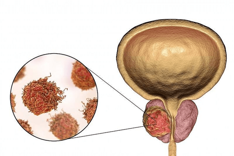 Wie sieht ein Prostataschaden aus