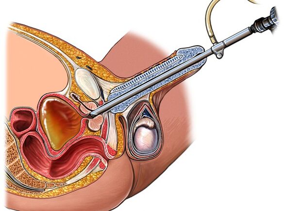 Behandlung von Prostatitis