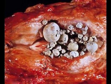 Chalkolithische Prostatitis