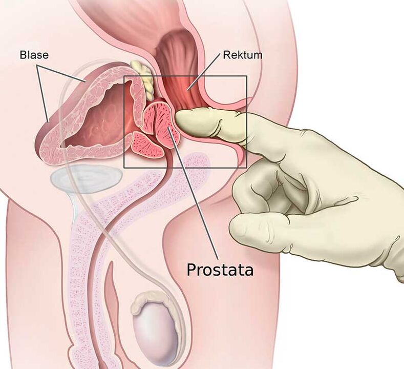Prostatamassage bei Prostatitis