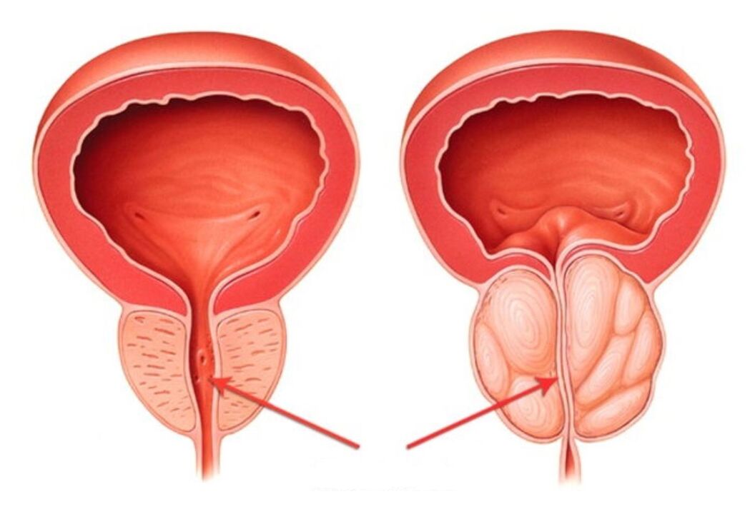 gesunde und entzündete Prostata mit Prostatitis