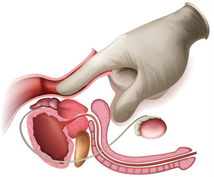 Prostatamassage